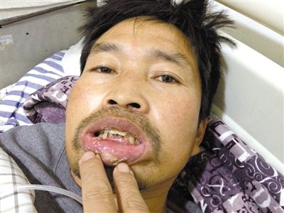昨日,阜阳第二人民医院,庄兴南称,嘴是1日在回家的车上被打肿的。新京报记者