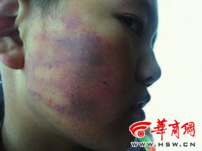 事发后第三天,小明脸上被打的痕迹仍然明显