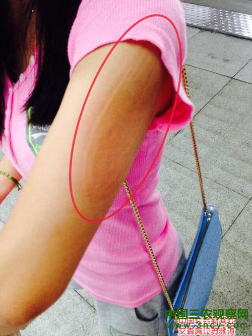 张女士手臂被夹两站路后留下的夹痕.jpg